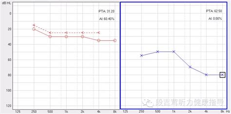 纯音测听,纯音测听报告怎么看结果缩略图