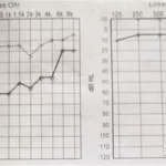 纯音听力测试,纯音听力测试报告单怎么看缩略图